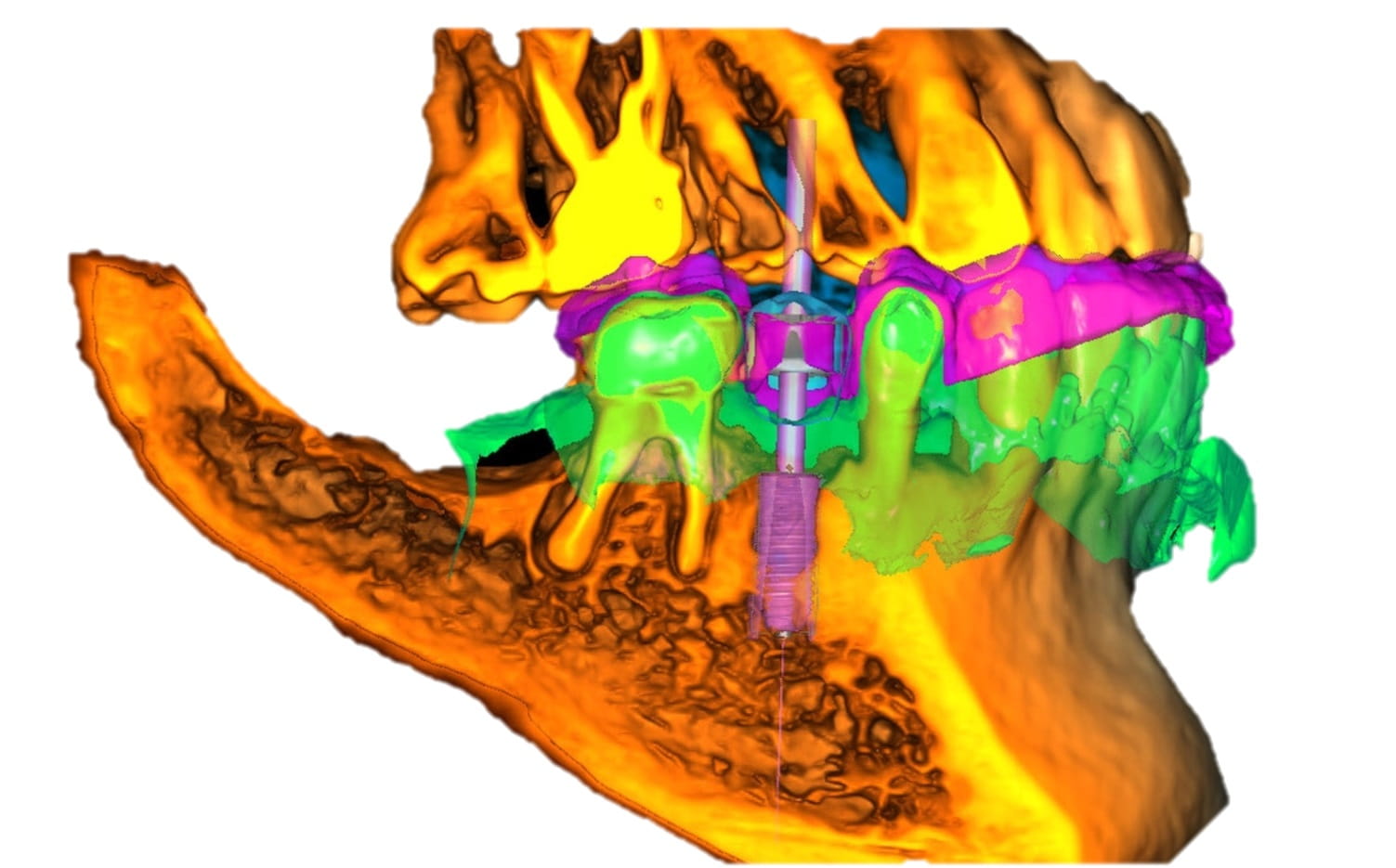 Digital Dentistry Full Jaw